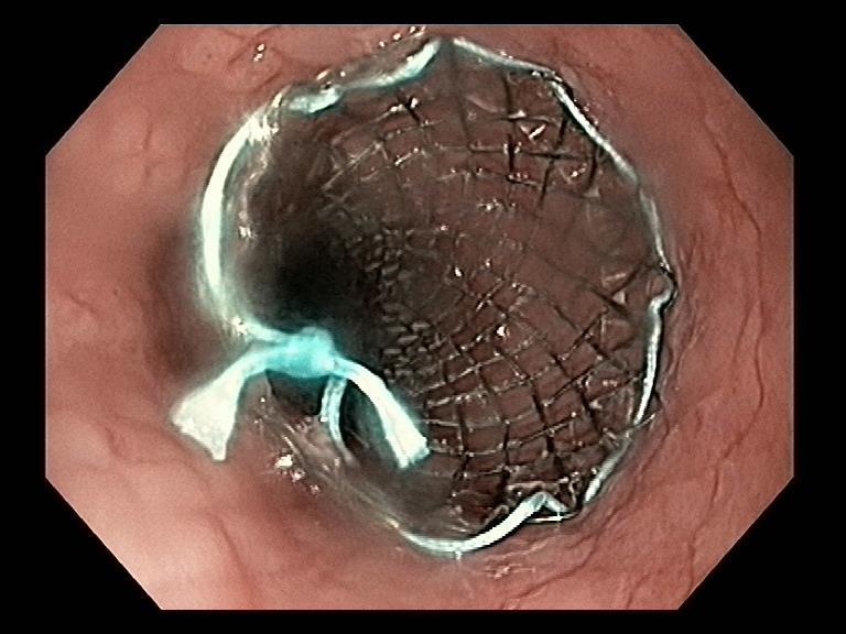 Stent på