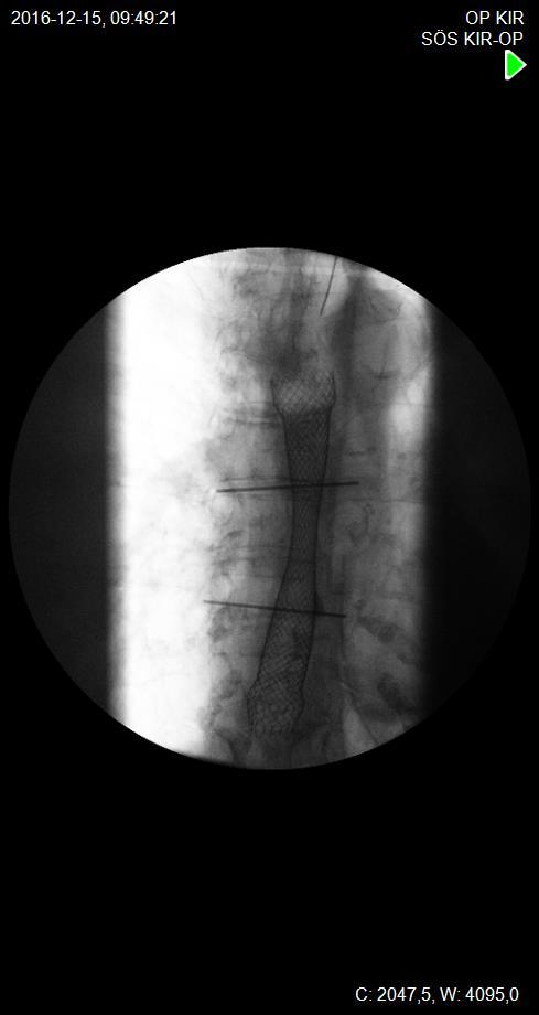 Stent med
