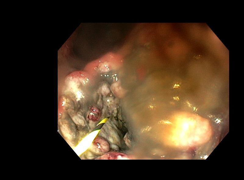 Distal ventrikelca