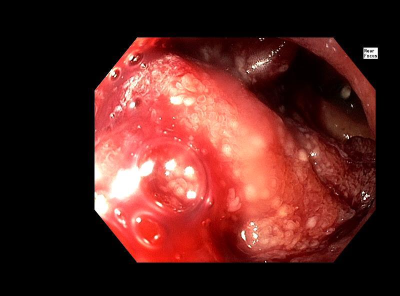 Tumörväxt duodenum,
