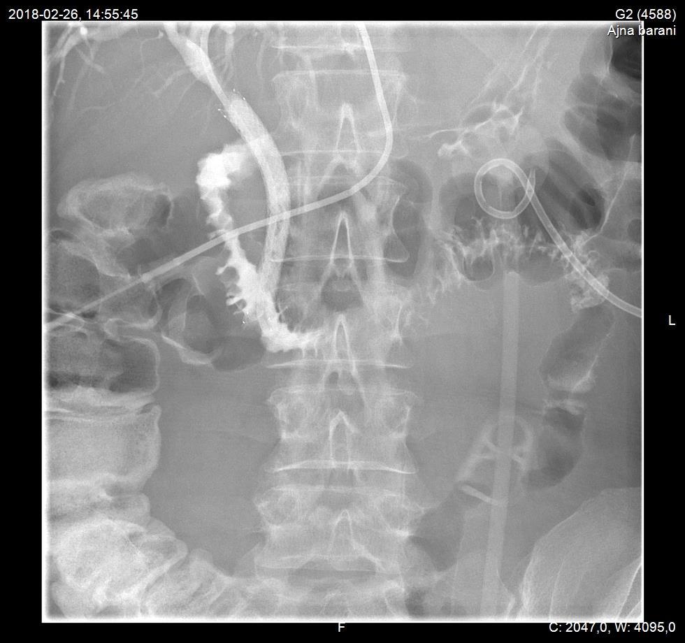 Ptc-lagd stent, dessutom har denna pat
