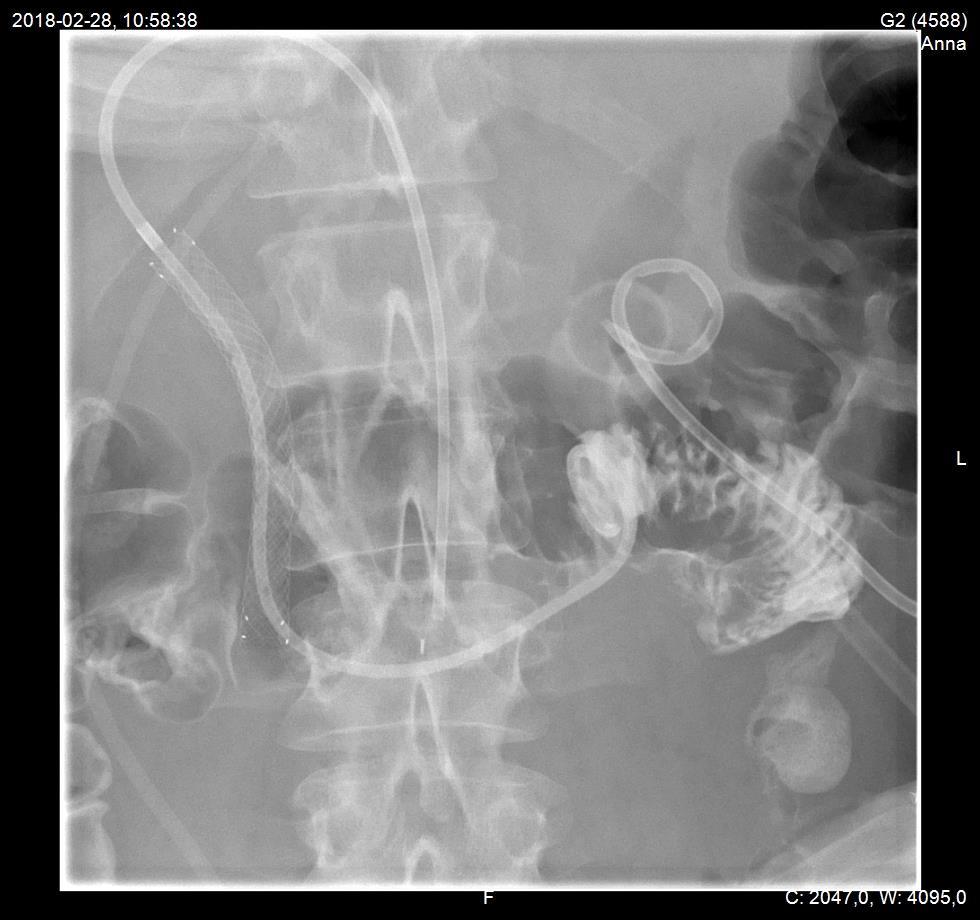 Stent + externt drän som hålls stängt.