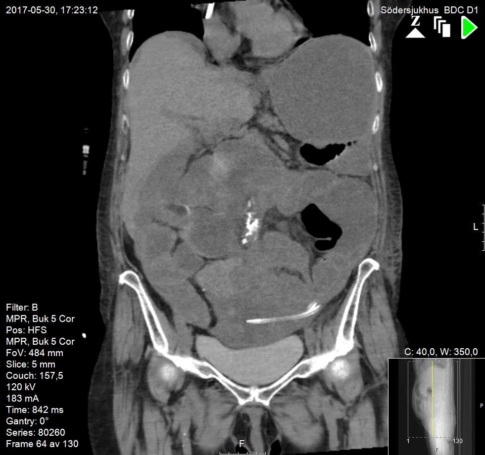 Ventrikelretention, dilaterade