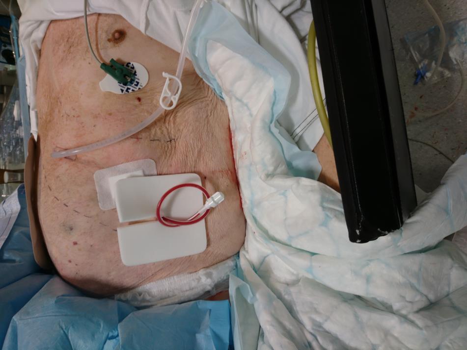 Pat med tid kolostomi,nu ileus med ascites och ventrikelretention.