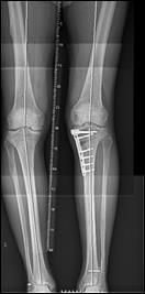 En platta sätts fast på insidan av knäleden för att fixera benet och därigenom ge förutsättning för läkning.