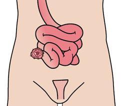 v 28+1 Beslut om sectio och avlastande ileostomi Fragmin, Flagyl, Prednisolon Fortsatta blödningar rektalt