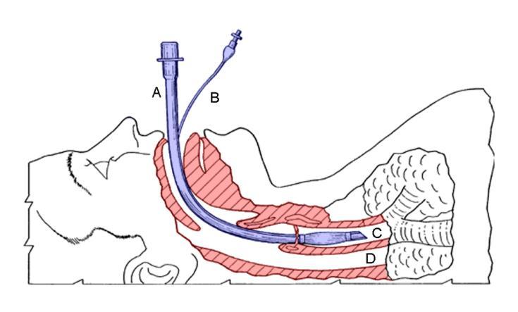 Endotrakealtub Bildkälla Wikipedia (2017) Figur 2. Placering av Endotrakealtub Metodval för fri luftväg I prehospital miljö jobbar ambulanssjuksköterskan hela tiden mot klockan.