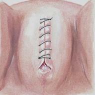 Typ 3: Infibulation/ Pharaonic circumcision