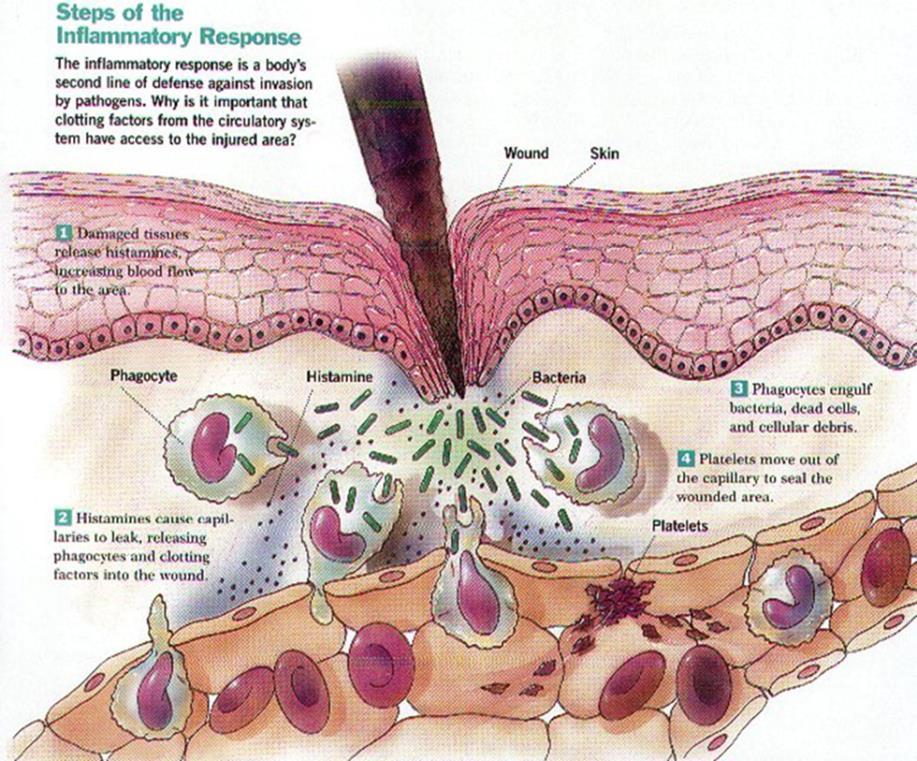 Inflammation kroppens reaktion på en infektion rodnad (ökat blodflöde) svullnad (vätska från blodet) värme smärta ämnet histamin frisätts från trasig