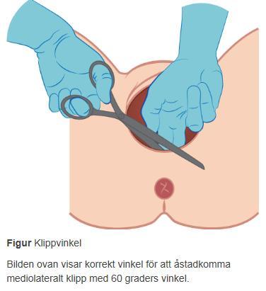 Sida 6 (25) Suturering av perineotomi/episiotomi Ett klipp innebär en skada inte bara på hud och slidans vägg utan även på muskler och muskelfästen.