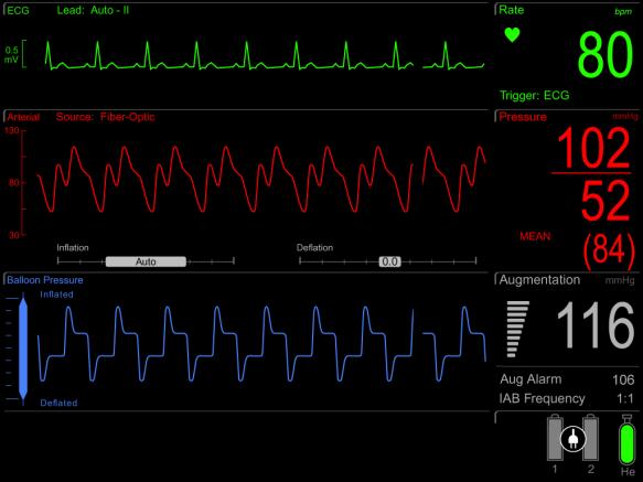 BAKGRUND Intra-Aortic Balloon Pump (IABP) är ett mekaniskt cirkulationsstöd som ger tillfälligt stöd för vänster kammare genom att öka koronarperfusionen och minska
