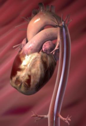 KONTRAINDIKATION Svår aortainsufficiens, aortaaneurysm, svår aortoiliakal förkalkning eller grav perifer kärlsjukdom FUNKTION Aortaballongkatetern läggs in via perkutant instick i arteria femoralis