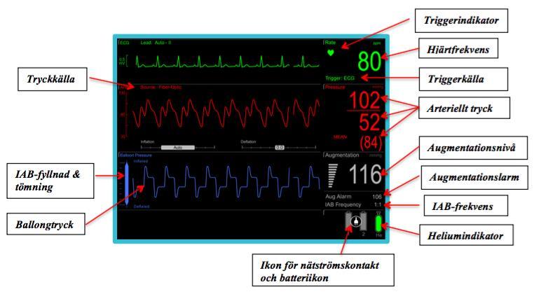 Monitor Fiberoptisk ballongkateter På toppen av ballongkatetern finns en fiberoptisk sensor som reagerar på tryckförändringar i blodet.