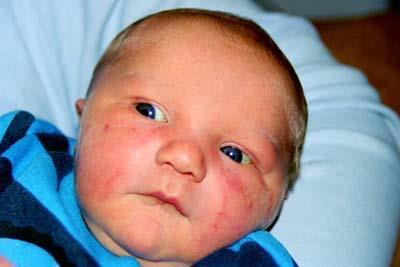 1. Allergisk reaktion vid introduktion av nytt födoämne Barn som reagerar vid introduktion av ett nytt livsmedel Handläggning: Fullständig allergianamnes samt lägg upp en plan Lindriga symtom: