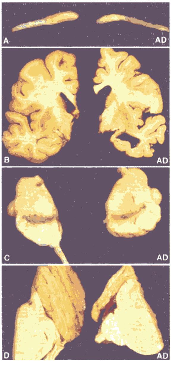 Semantiskt Självbiografiskt Implicit inlärning Språklig förmåga Expressiv Benämning