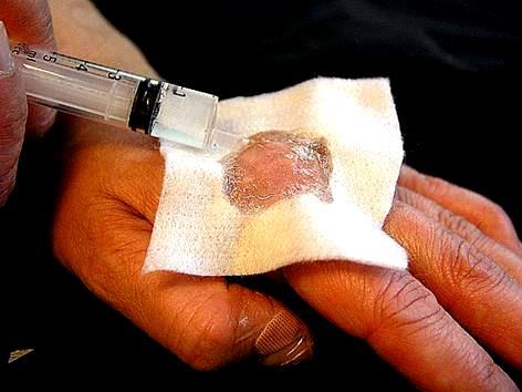 Blottlagd sena-håll koll på fukten Täck såret och ett par cm utanför såret med