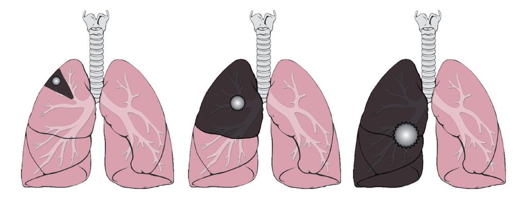 Operationsmetoder Om ingreppet görs för att bota lu läckage (pneumothorax) från lungan kan man o a använda titthålsteknik.
