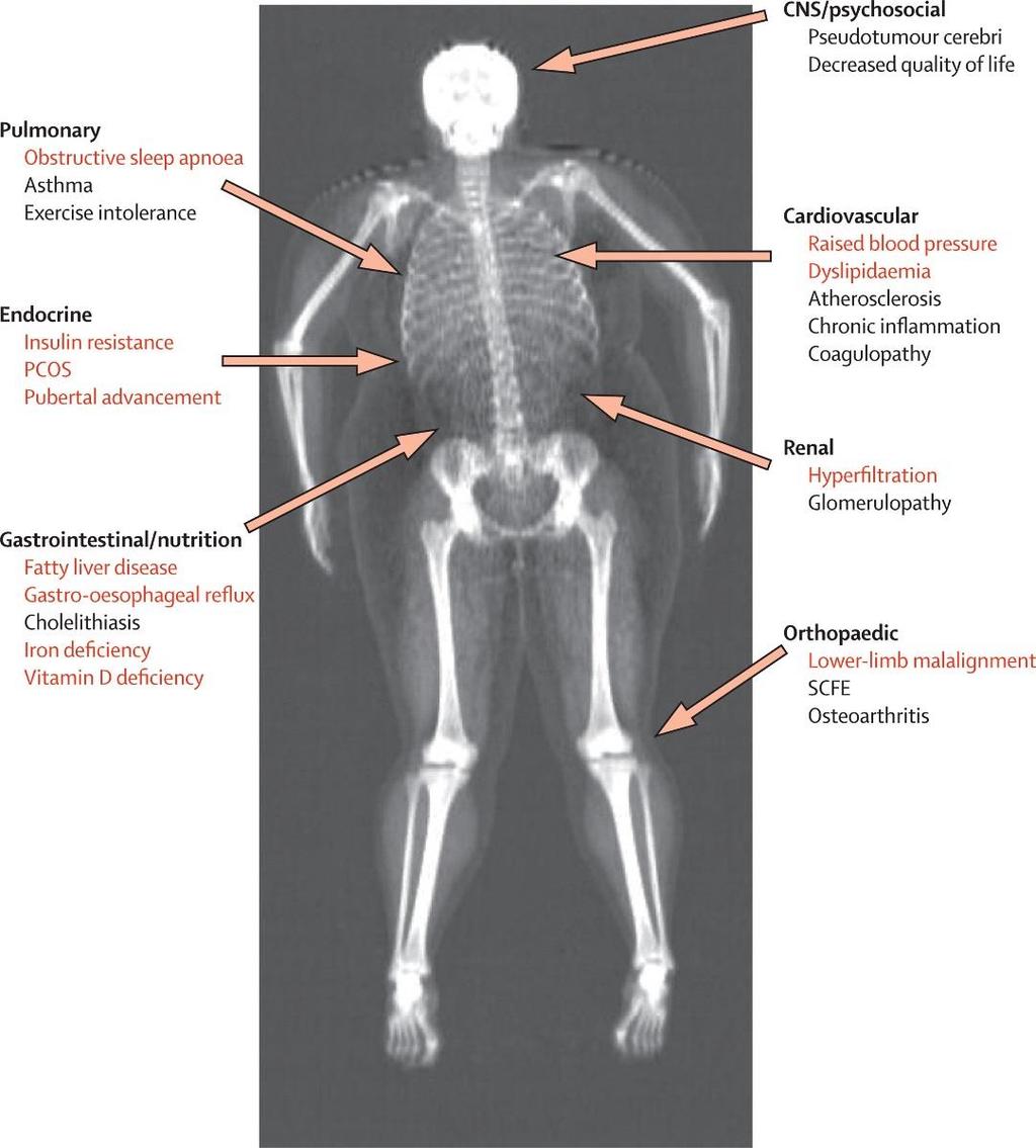 Komplikationer till fetma hos barn och ungdomar Röntgenbild av en flicka i tonåren med BMI 38 kg/m 2 Sjukdomar som är tydligt associerade med barnfetma är rödmarkerade
