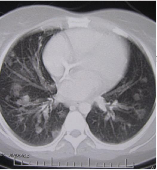 Etiologin till CVID med granulomatös