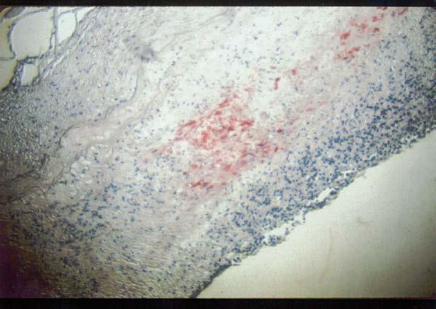 VZV antigen detektion i a.