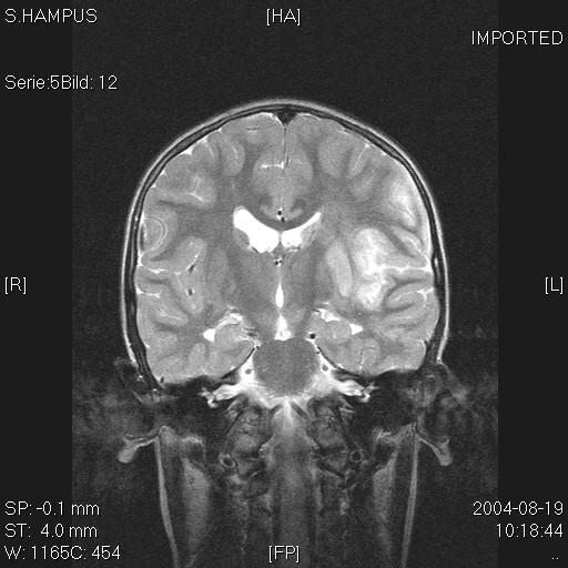 Kliniskt spektrum av VZV CNS vaskulopati Large vessel granulomatous angiitis (acute hemiplegia after contralateral trigeminal zoster in adults)