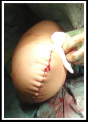 Fall 2 TTA vänster 2017-09-11 Sagittal incision
