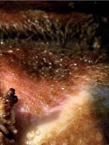 s/ Wart growth/