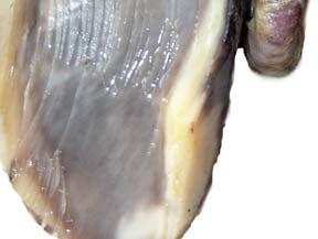 fibroma