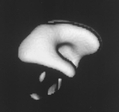 Klinik och vetenskap Förkortningar SA = subaraknoidalrummet NPH = mormaltryckshydrocefalus (Normal Pressure Hydrocephalus) HPH = högtryckshydrocefalus (High Pressure Hydrocephalus) FMO = foramen