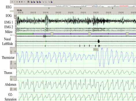 26 Riktlinjer för utredning av misstänkt sömnapné hos vuxna 2018 g) Respiratory Effort Related Arousal (RERA) Polysomnografi med registrering av sömnstadier (EEG, EOG, EMG), här lättsömnstadium 2.