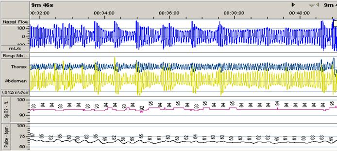 Riktlinjer för utredning av misstänkt sömnapné hos vuxna 2018 27 h) Andning som vid Upper Airway Restriction Syndrome (upprepade RERA events) Bilden visar upprepade RERA-misstänkta events med mycket