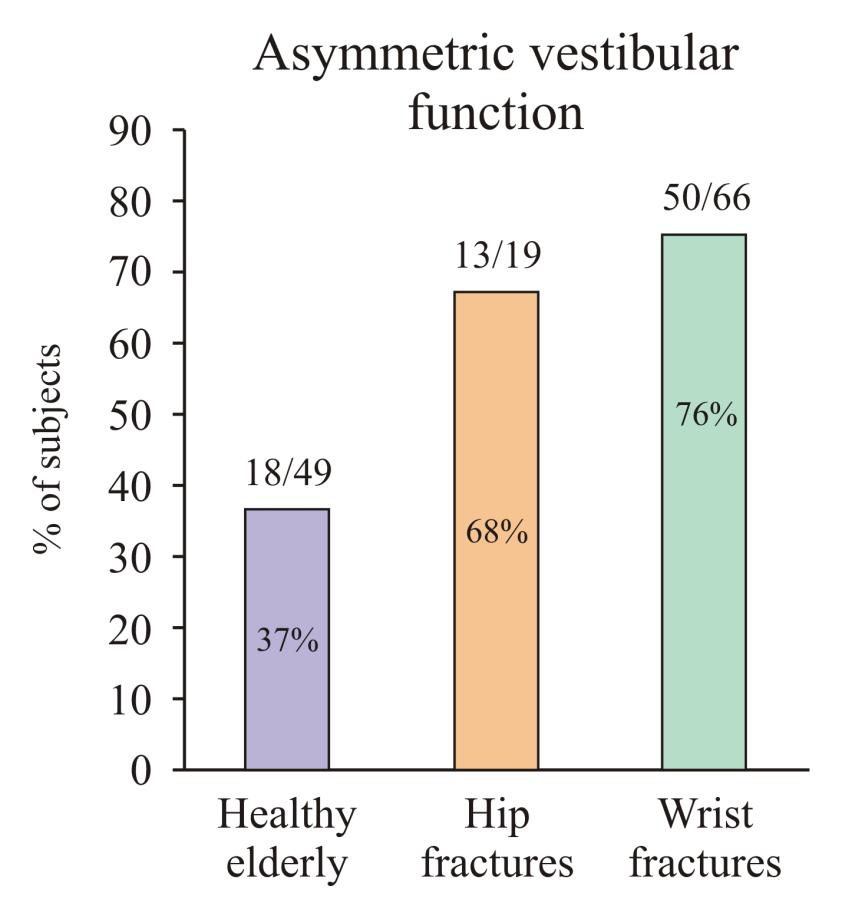 äldre fraktur patienter Vestibular degeneration, leading to asymmetry: % 90 80 70 60 50 40 30 20 10 0 18/49 Friska kontroller 13/19 Höft frakturer 50/66 Radius Frakturer 1/3 av friska pensionärer har