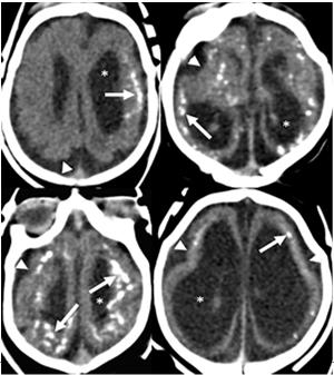 Associated ultrasonographic findings in fetuses with microcephaly because