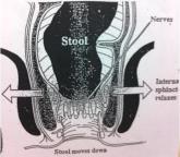 Rektoanal inhibitionsreflex Sampling Att hålla emot vid trängning