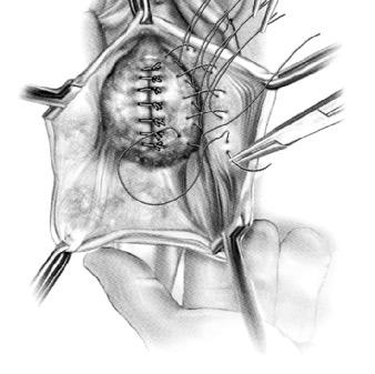 Kirurgi och framfall Främre och bakre plasvk, klassisk med egen vävnad = midline plicavon Hög recidivrisk! Anatomiskt upp mot 40-50%. Symtomatiskt 25%. 10% reopereras.