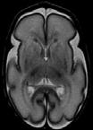 påverkar neurologisk utveckling (13 studier) ELBW barn Försenad postnatal tillväxt