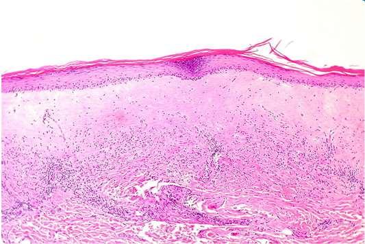 Lichen sclerosus allmänt 10% av patienterna har extragenitalt engagemang. K:M=10:1 (4-5:1). Hos 1/30 äldre kvinnor. Prevalens hos barn okänd. Övre delen av dermis är hyaliniserat.