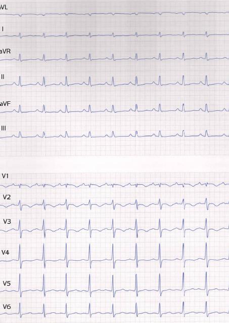 3. Ett EKG togs direkt vid ankomsten. Vilken blir din EKG diagnos?