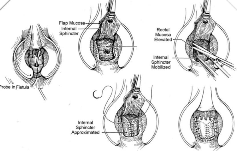 Advancement flap