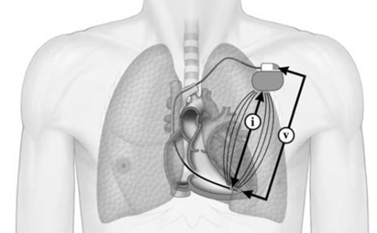 Bilaga A: Beskrivning av minutventilation för MV-produktinformationen från december 2017 Boston Scientifics pacemakrar använder transtorakal impedans för att mäta MV som är en produkt av