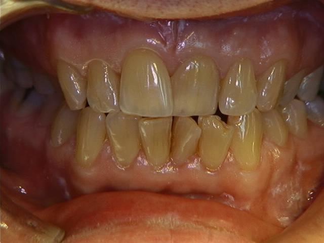 Friska tänder, ung och äldre person Odontologiska