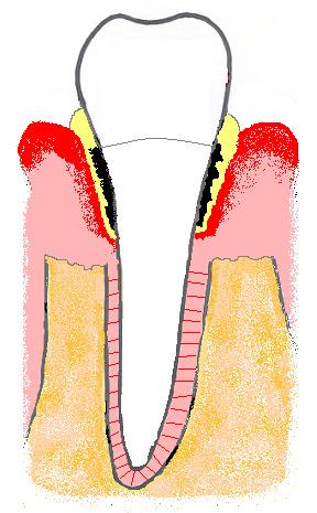 sambandet mellan obehandlad parodontit och svårinställd diabetes, troligen finns det samband som visar att HbA1c sjunker vid icke