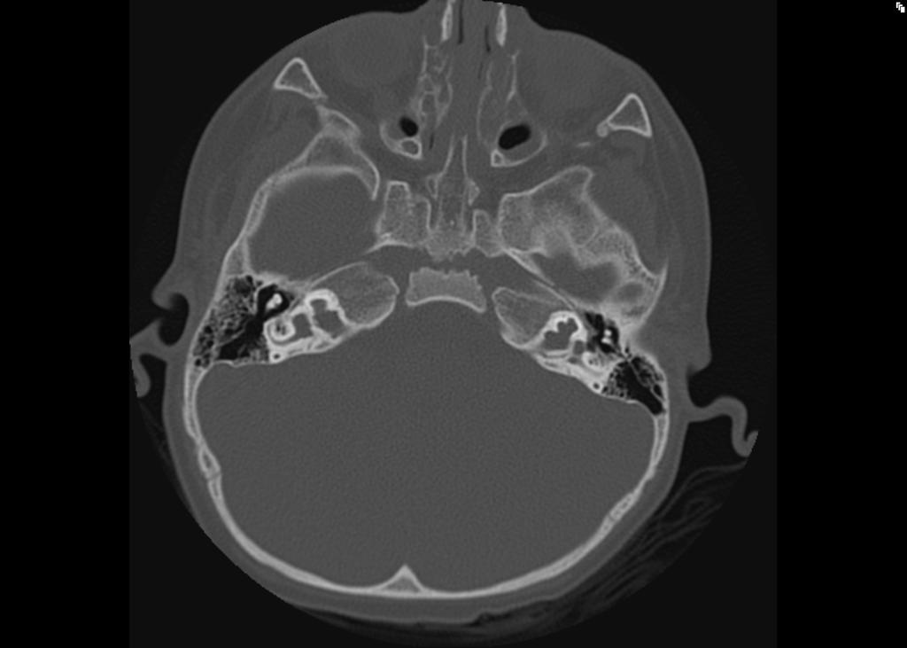 X-Linked progressive mixed hearing