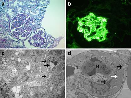 C3-glomerulonefrit Mindre känt om prognos jmf m DDD, trol ngt bättre C3 i glomeruli, ej Ig (immunfluorescens) Inga dense deposits Defekt reglering av alternativa vägen, ev terminala vägen aktiverad