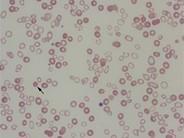 Talassemia major blodutstryk Uttalad mikrocytos Hypokromasi Polykromasi Transfunderade blodkroppar = sfärocyt från blodgivare Fraktionerade hemoglobiner Analysprincip: katjonbyteskromatografi (HPLC)