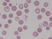 Sickle cell anemi II Ansamlingar av siderotiska granulae i periferin av hypokroma erytrocyter Verifieras med järnfärgning Sickle cell anemi HbS - punktmutation i β globingenen Deoxygenering av HbS