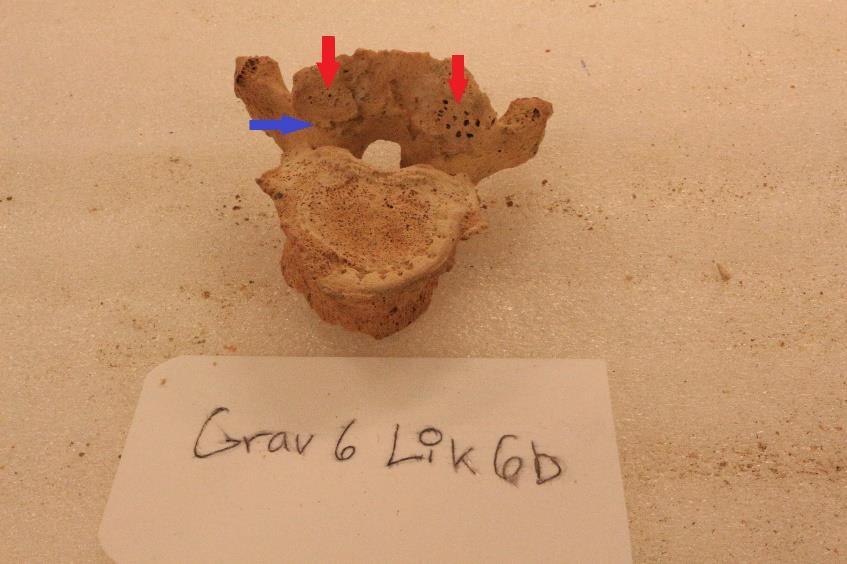 Bild nr.5 röd pil pitting blå pil osteofyter. Individ 6 grav 6 lik 6b. Foto Petra Carlsson 3.2. Sex individer från fjärde och femte dynastin under gamla riket Gravanläggningar 1-3 Grav 1.