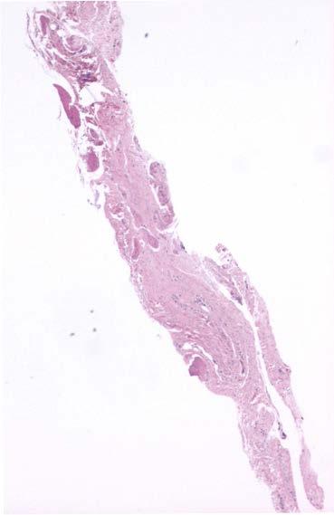 BiBBInstruments utvecklar biopsiinstrument under varumärket EndoDrill som möjliggör bättre och tidigare cancerdiagnostik i jämförelse med konventionella biopsi-instrument.