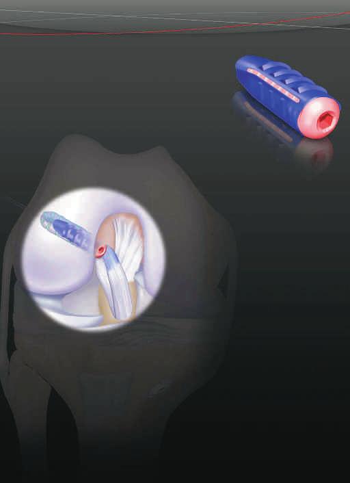 ACL RECONSTRUCTION SYSTEM DePuy Mitek s NEW Solution for Anatomic ACL Reconstruction Restoring the Anatomic ACL Footprint Improved ACL Footprint Placement & Coverage* Utilizes a patented sheath and