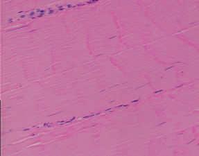 Fig 6. Fotografi av ljusmikroskopifynd från en öppen biopsi från patellarsenan hos en 25-årig manlig patient tagen i samband med en korsbandsoperation för att tjäna som kontroll.